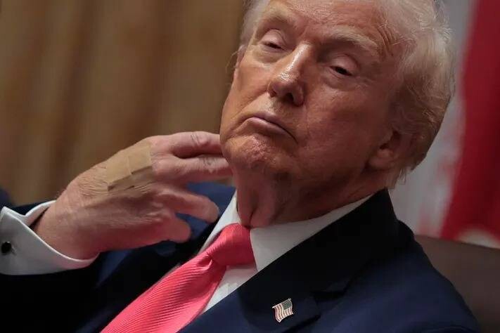 Bandages on Trump's hand result from frequent handshakes