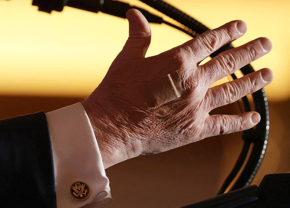 White House Justifies President's Hand Bandage