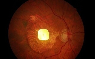 New Implant Restores Sight for Patients with Macular Degeneration