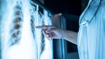 Inflammation Plays Key Role in Early Lung Cancer Development