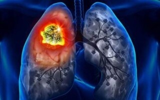 Lung Cancer in Non-Smokers: New Risk Factors