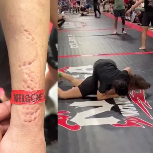 Jiu-jitsu athlete shows bite marks after fight in Miami